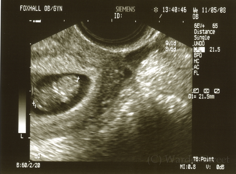 1st Ultrasound.jpg